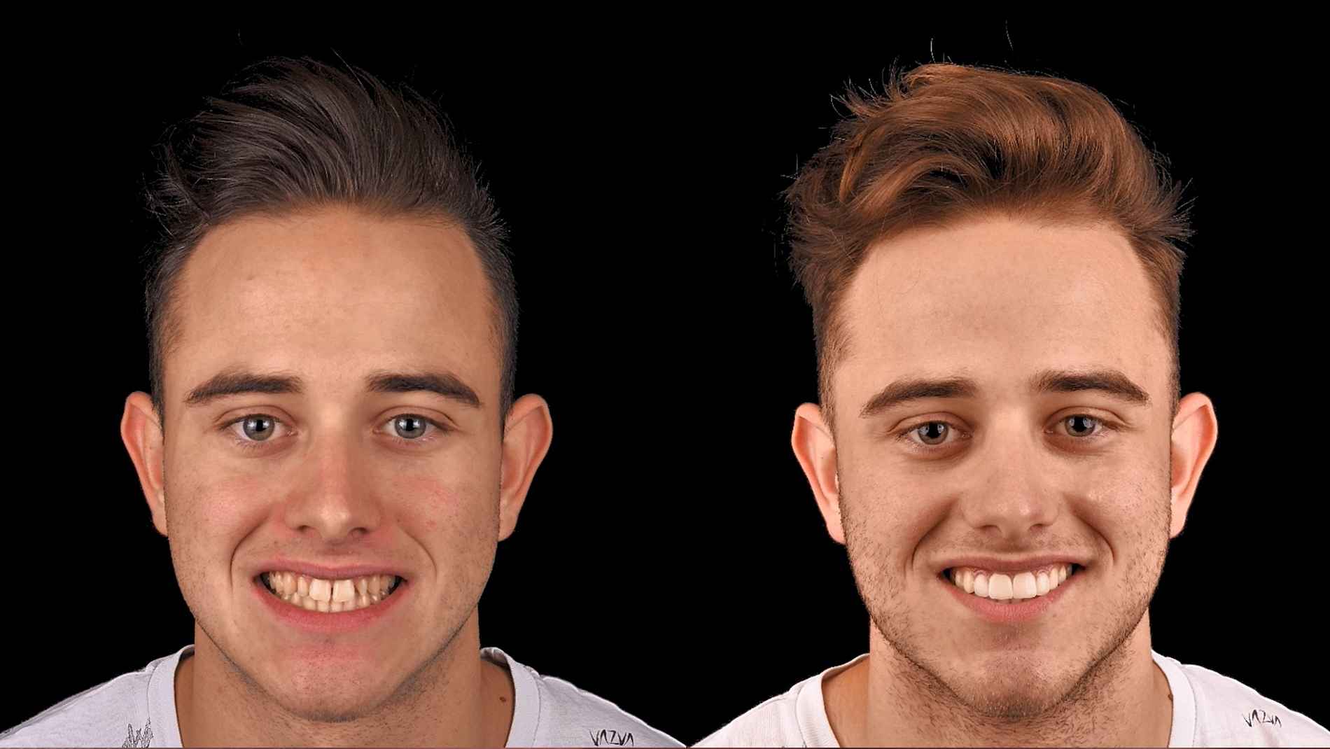 antes y despues blanqueamiento dental