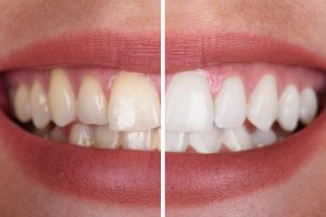 blaqueamiento dental