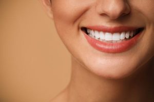 carillas dentales