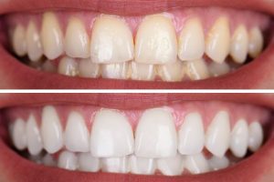 blanqueamiento dental