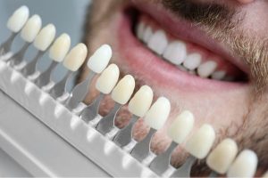 diferencia entre carillas dewntales de composite y porcelana