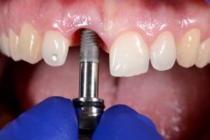 implante dental