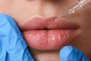 acido hialuronico en labios