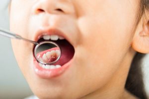 caries en dientes de leche