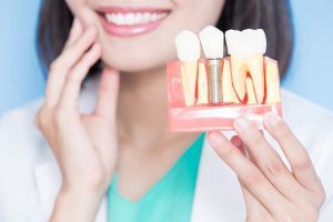 proceso de colocación de un implante dental