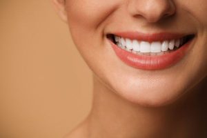 carillas dentales