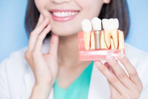 cuidados despues de un implante dental