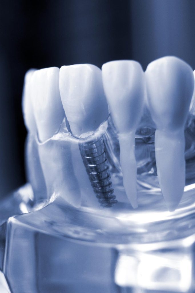 Colocación de implantes dentales en la Clínica Dental Alberto García Valladolid