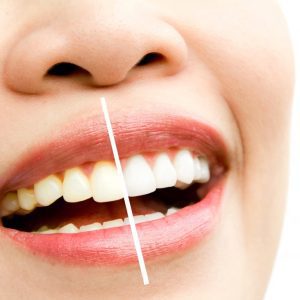 Resultados de blanqueamiento dental en la Clínica Alberto García Valladolid