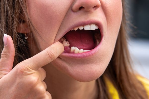 Diferencias entre endodoncia y extracción dental en Valladolid